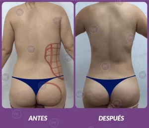 Lipotransferencia 10